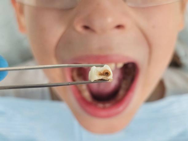 Best Emergency Wisdom Teeth Removal in Vero Beach South, FL